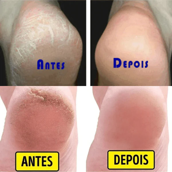 Removedor de calos e rachaduras Beauty Feet